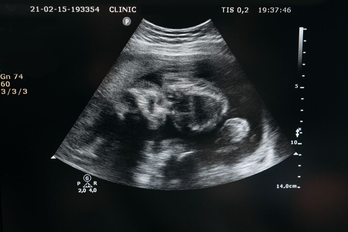 Ultrasound scan showing the image of an unborn child in the womb, highlighting pregnancy and healthcare.