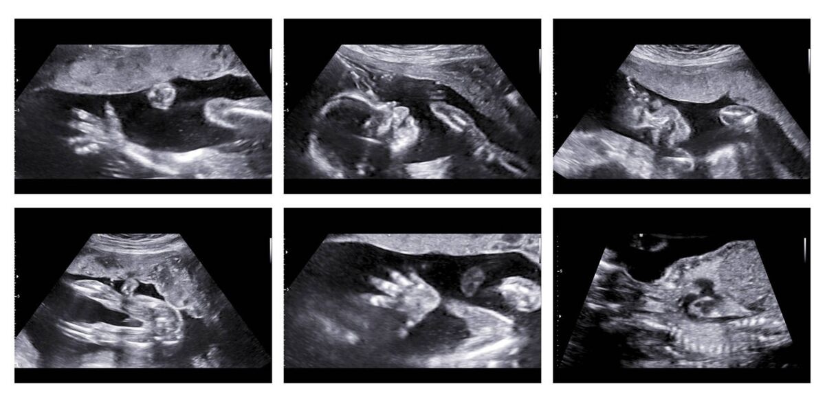 A prenatal ultrasound scan