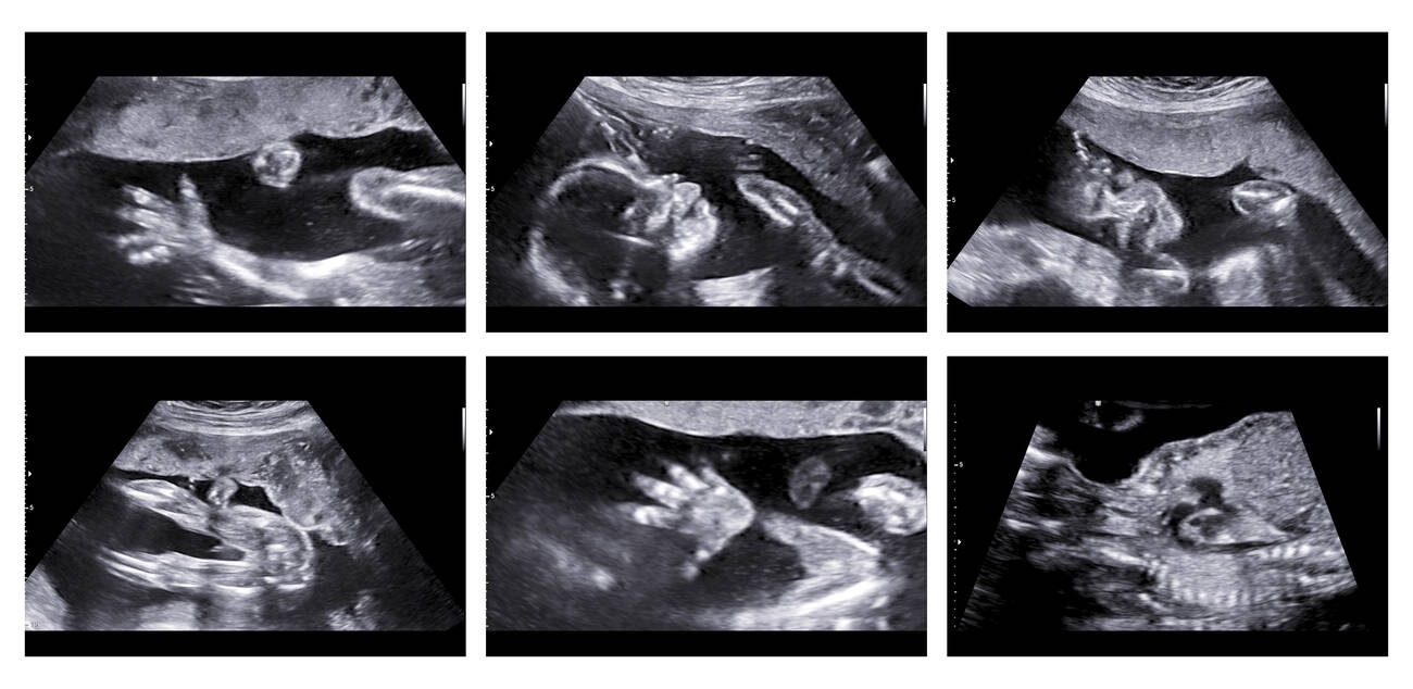 A prenatal ultrasound scan